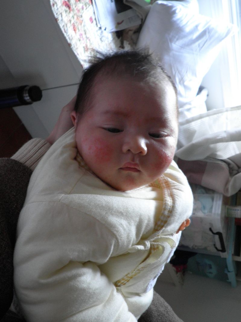 我家一一湿疹前后对比(8楼有新照片,昨晚刚拿