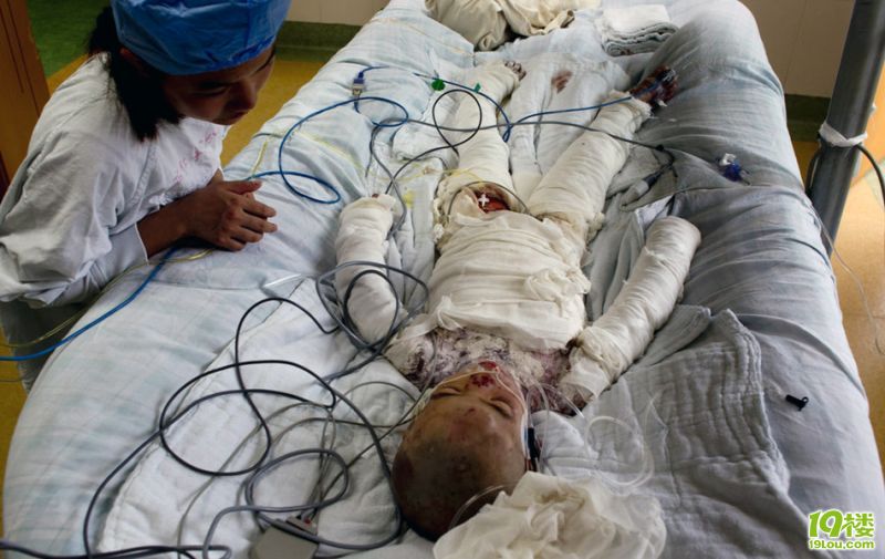 7岁女童遭生父开水淋烫续:头面部发现棍打痕迹