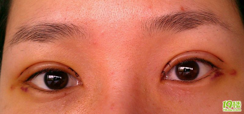 范希玲,割双眼皮(韩式三点)2012.2