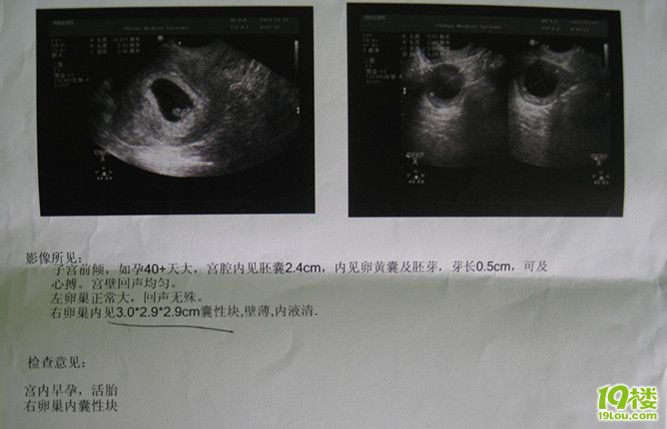 今天检查,怀孕40+天,右侧卵巢囊块,请问要紧吗