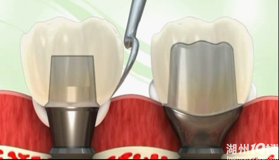 为什么要选择使用个性基台做修复呢?-安吉论坛