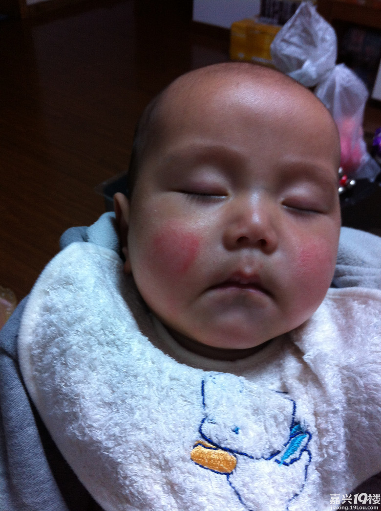 如何不让湿疹伤害宝宝稚嫩的肌肤?-宝宝求助-