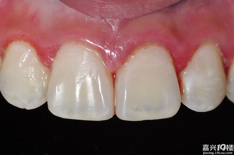 牙医日记 科普:牙齿折断了怎么办