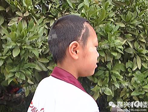 嘉兴12岁<em>女孩头痛</em>四年 脑中取出条20厘米长的