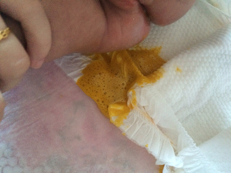 【儿科】宝宝拉泡沫样的粑粑是不是拉肚子了