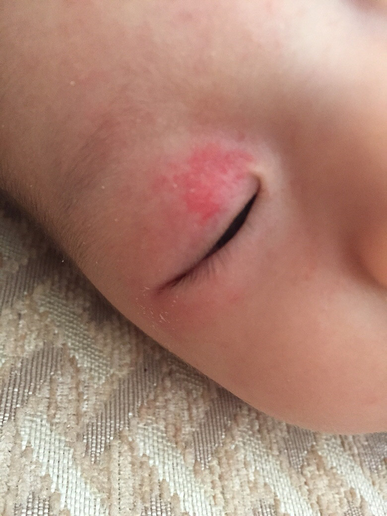 ҽ�� ��������������Ƥ���к�� ���ڻ�û