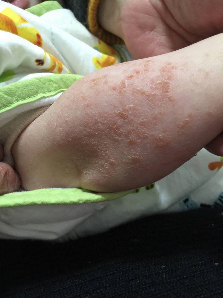 ҽ�������£������ֱ��Ϸ��˺ܶ࣬��ʪ����