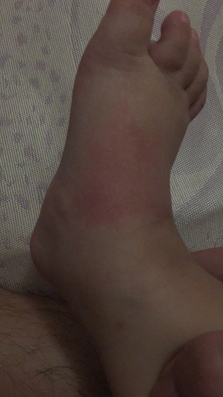 һ�����죬С���ӵĽžͱ�ҧ�Ĳ��ܿ��ˣ���ô�죿