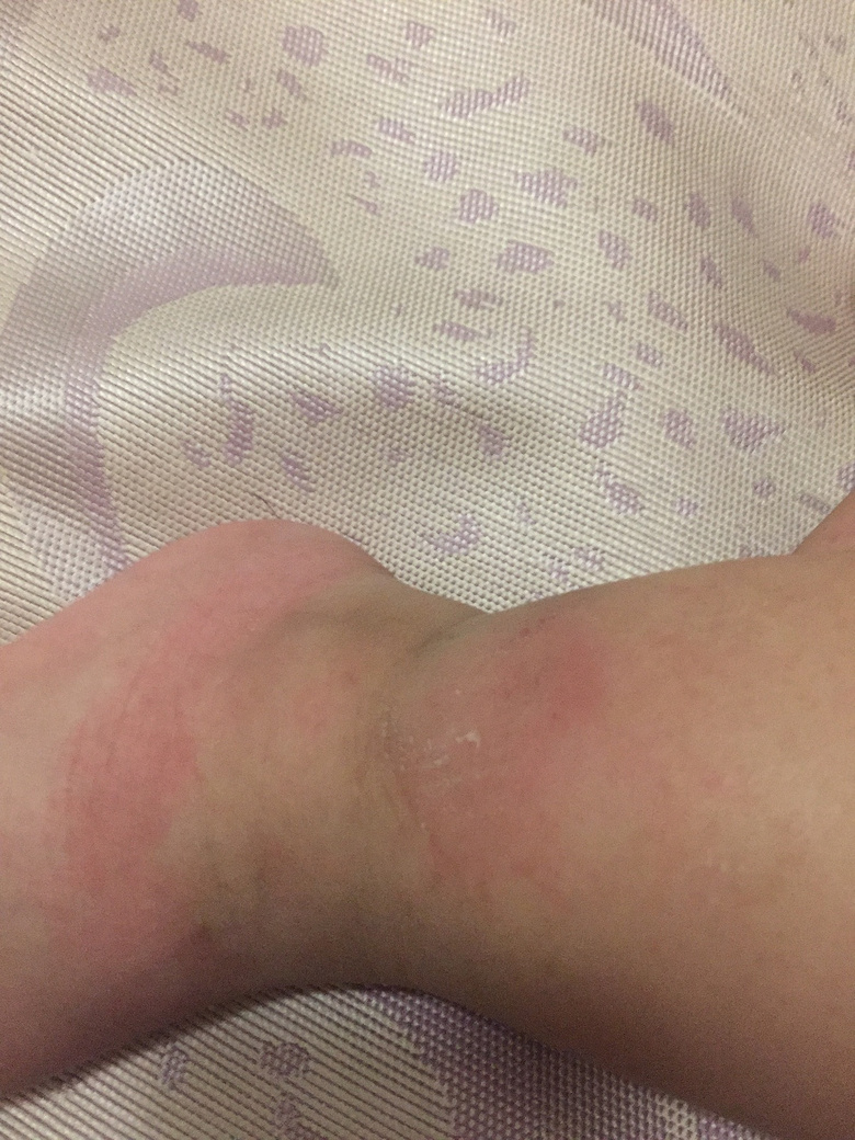 һ�����죬С���ӵĽžͱ�ҧ�Ĳ��ܿ��ˣ���ô�죿