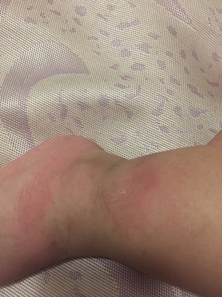 һ�����죬С���ӵĽžͱ�ҧ�Ĳ��ܿ��ˣ���ô�죿