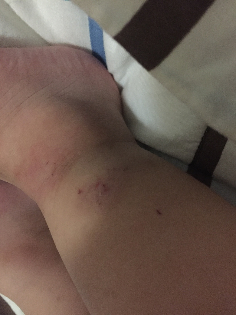 һ�����죬С���ӵĽžͱ�ҧ�Ĳ��ܿ��ˣ���ô�죿