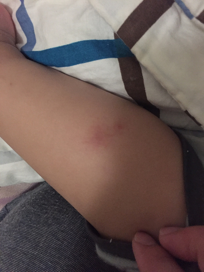 һ�����죬С���ӵĽžͱ�ҧ�Ĳ��ܿ��ˣ���ô�죿