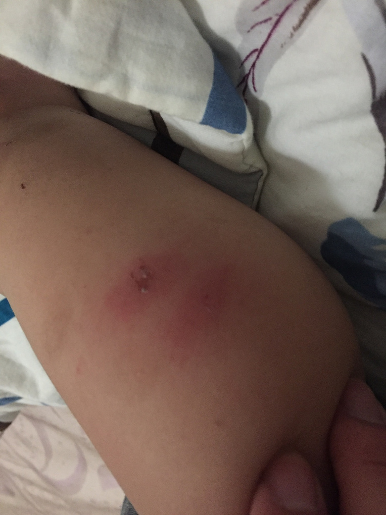 һ�����죬С���ӵĽžͱ�ҧ�Ĳ��ܿ��ˣ���ô�죿