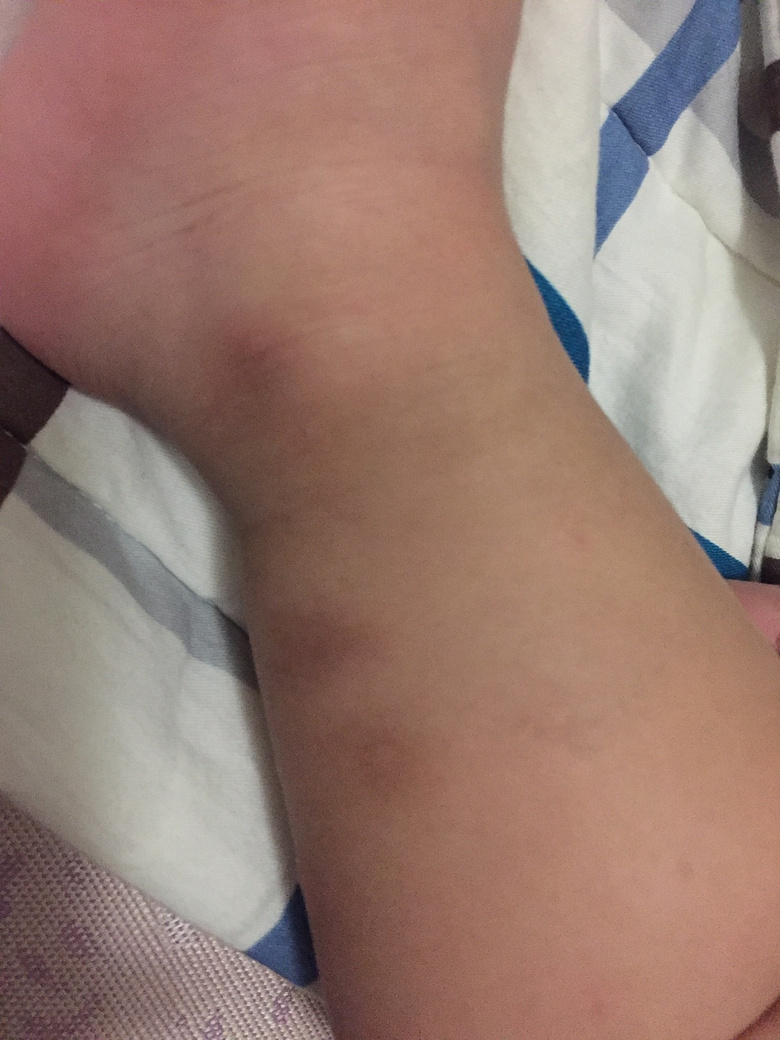 һ�����죬С���ӵĽžͱ�ҧ�Ĳ��ܿ��ˣ���ô�죿