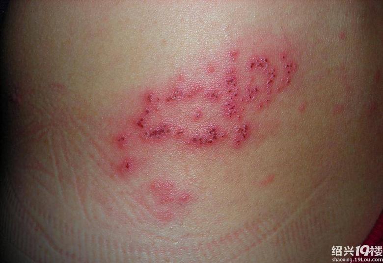 自从我得了蛇缠病,男友就再也没有跟我做爱了