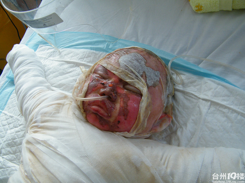 2岁萝莉被火烧伤生命垂危-教育-台州19楼