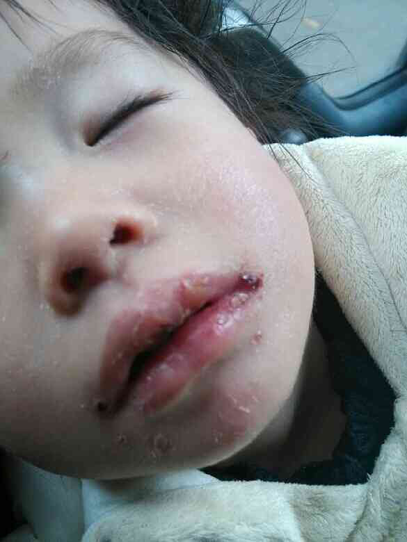 求救!小孩子得了麻疹(风疹)嘴巴烂了!-幼儿期(1