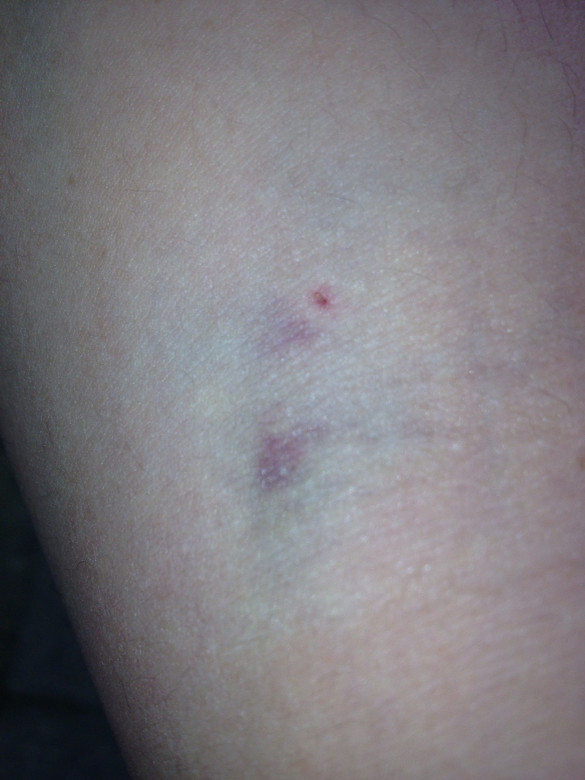 可能是献血后的不良状况!请了解人说说-讲白搭