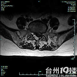台州哪里能治疗腰椎间盘凸出-讲白搭-台州19楼