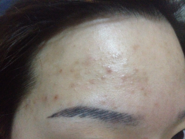 痘痘粉刺长成这样怎么能好.-讲白搭-台州19楼