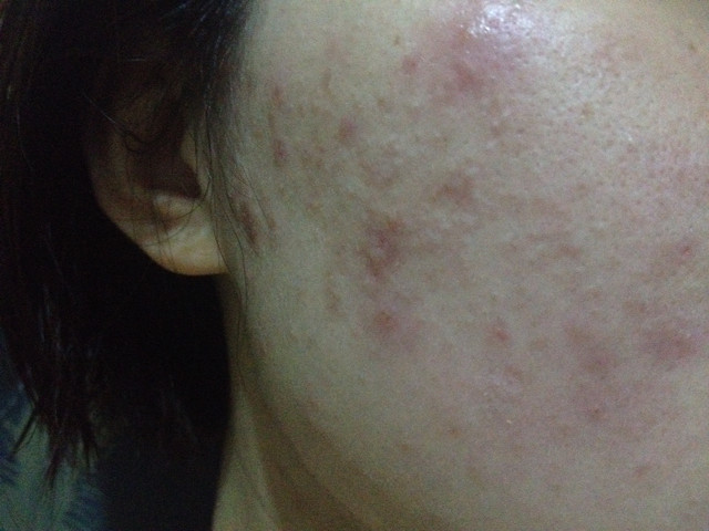 痘痘粉刺长成这样怎么能好.