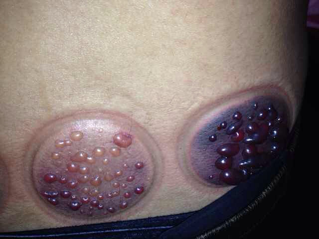 恐怖,拔火罐拔成这样,这还是湿毒血水吗?-讲白