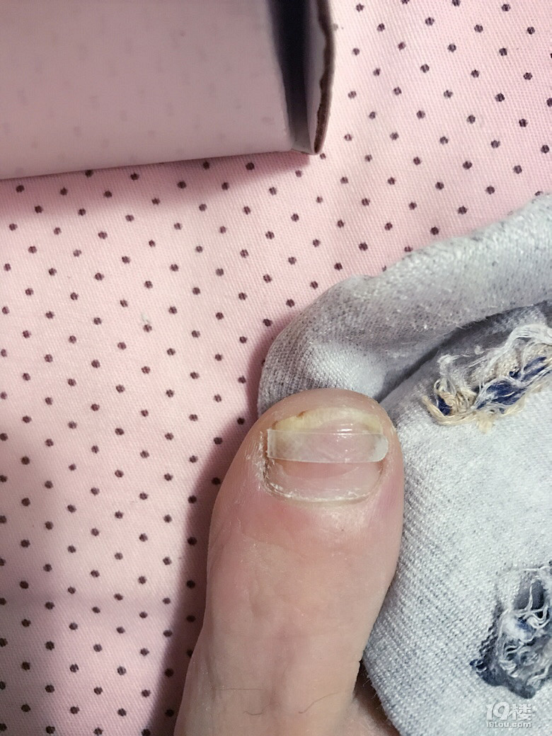 我就是一个典型的甲沟炎嵌甲悲催的案例