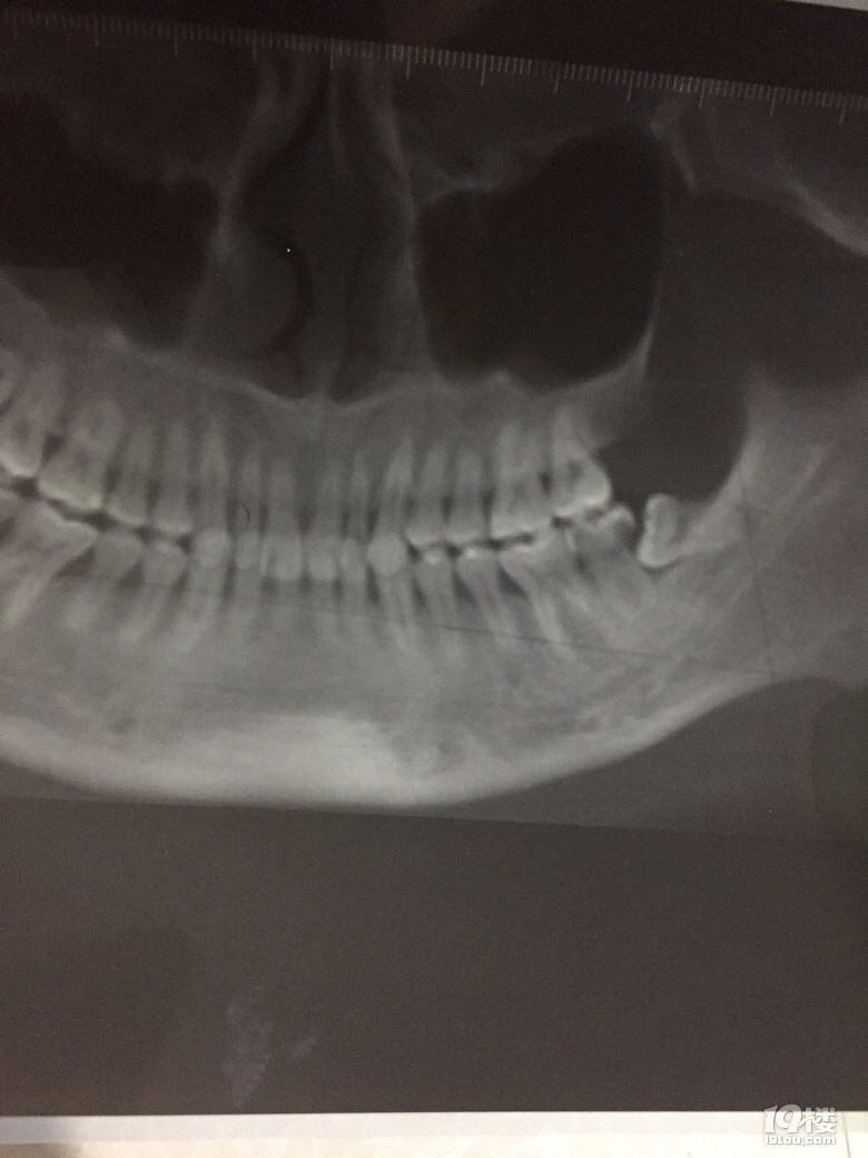 有没有会看片的或者医生帮我看下右下方智齿隔