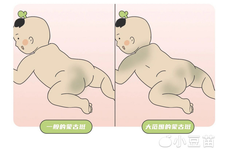 宝宝青屁股是福气这3种胎记家长要格外当心