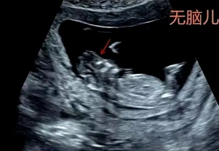 产检发现胎儿是无脑儿劝妈妈引产终止妊娠她犹豫了