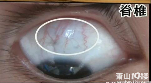 教大家目诊--通过看眼睛来预测疾病-大杂烩-爱