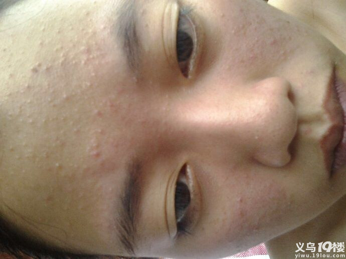 说一说我自己去除闭口粉刺的心得-美容美颜-时