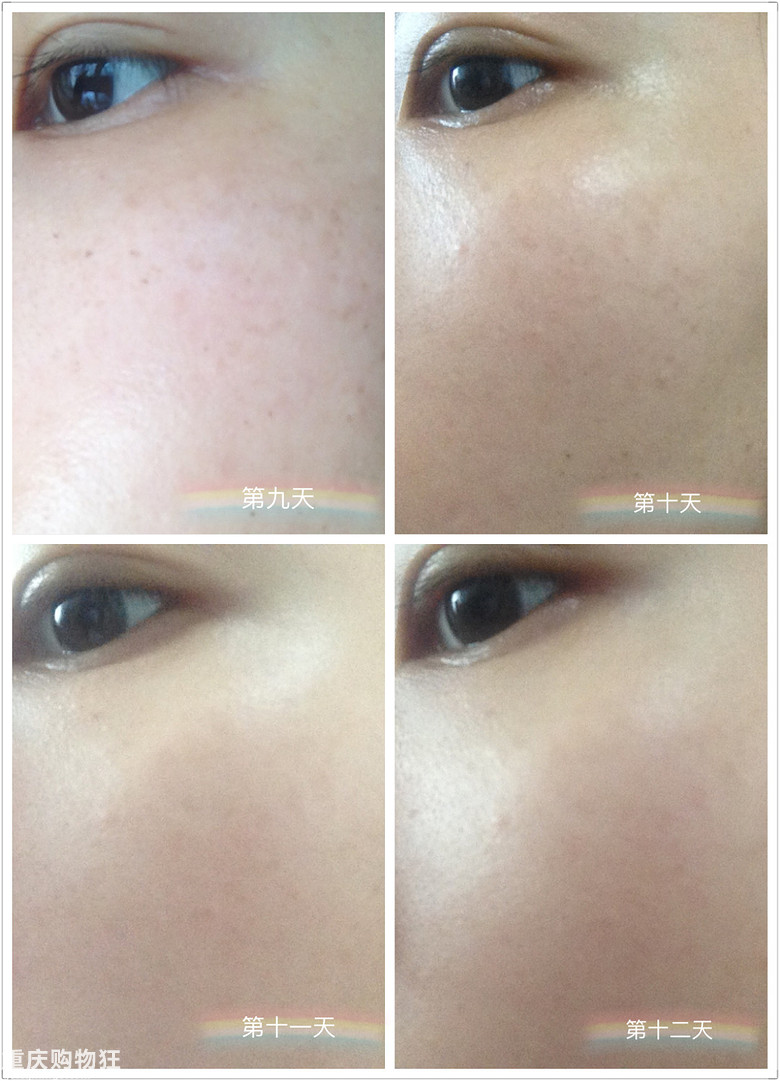 反馈贴来咯:OPT2激光美肤,仅做一次,斑斑真得掉了