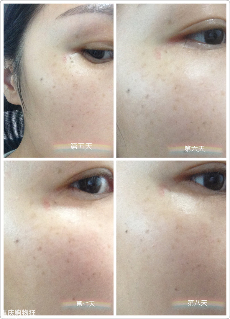 反馈贴来咯：OPT2激光美肤，仅做一次，斑斑真得掉了