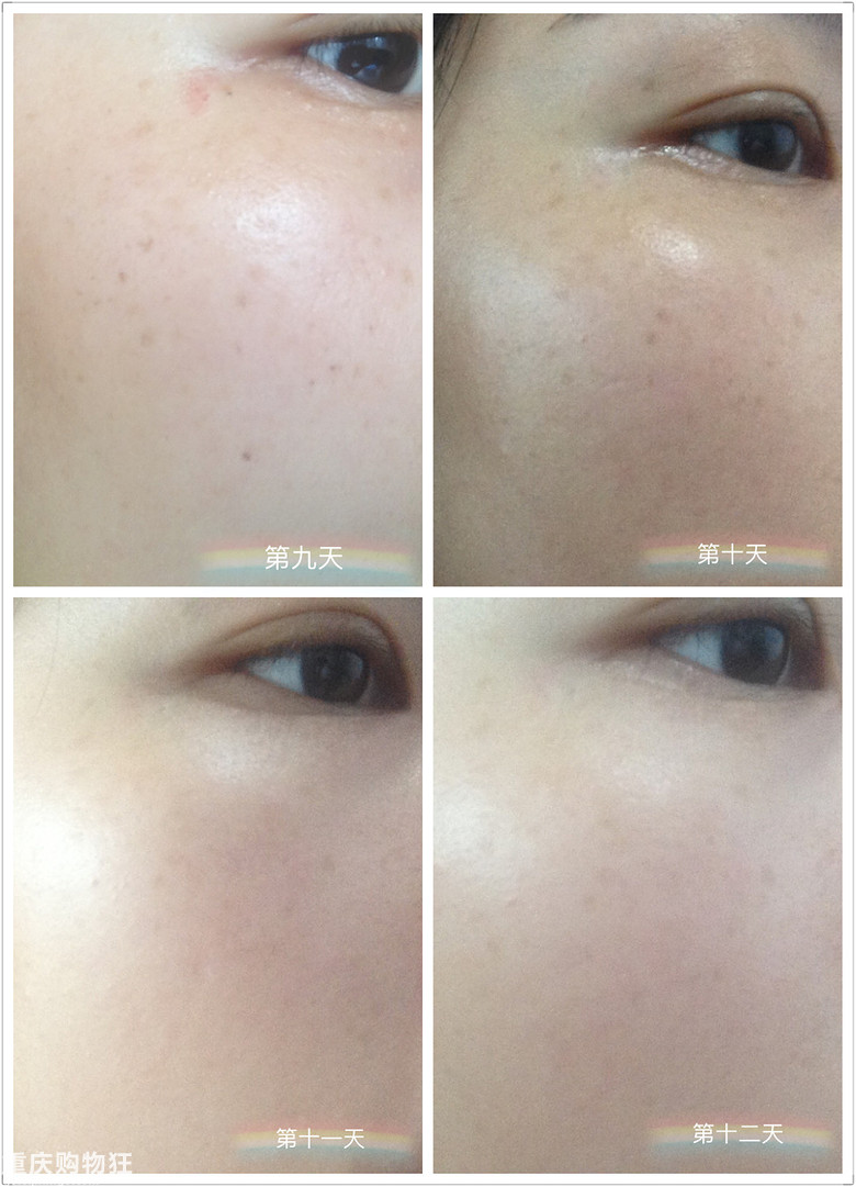 反馈贴来咯：OPT2激光美肤，仅做一次，斑斑真得掉了