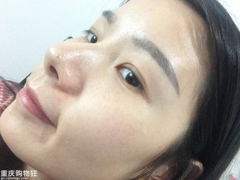 反馈贴来咯：OPT2激光美肤，仅做一次，斑斑真得掉了