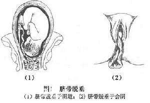 脐带脱垂孕妇有感觉吗？