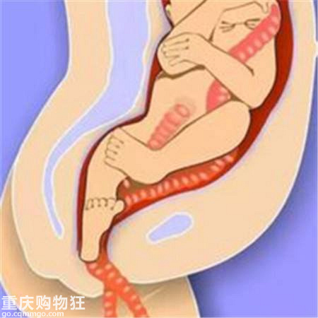 脐带脱垂孕妇有感觉吗?