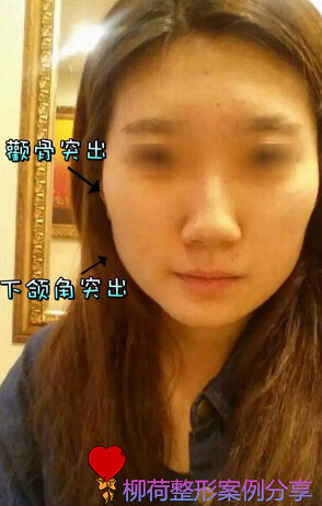 颧骨内推手术恢复时间%¥下颌角手术最好的医院