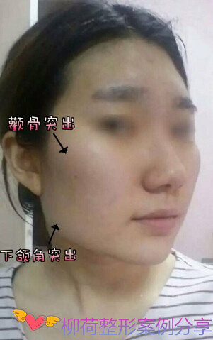 颧骨内推手术恢复时间%¥下颌角手术最好的医院