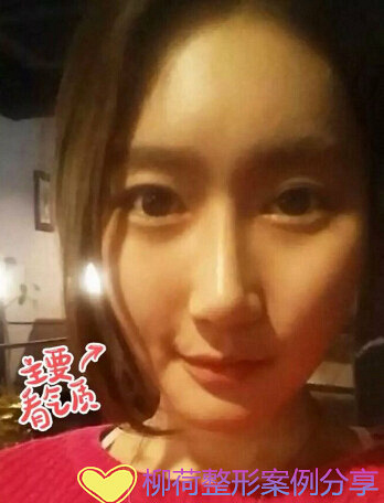 颧骨内推手术恢复时间%¥下颌角手术最好的医院