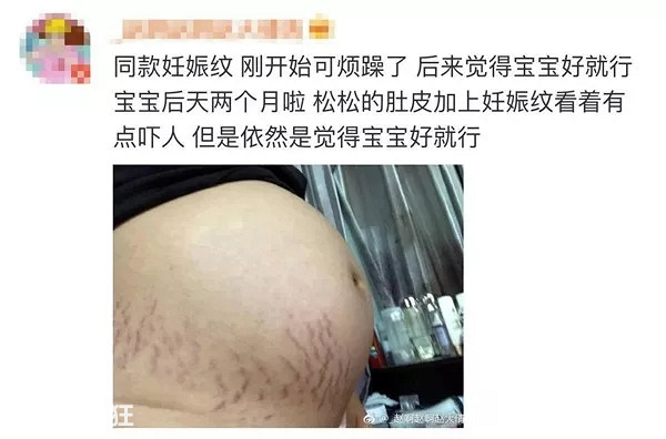 hold住姐晒“恐怖”孕照，长不长妊娠纹真的看体质【孕期龙门阵】