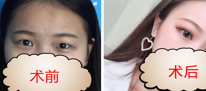 �ɶ���˫��Ƥ��������������˫��Ƥ������ʳ��Ҫע��ʲô