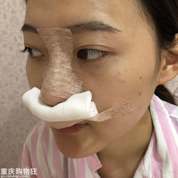 隆鼻三个月后，我出门都喜欢素颜+【变美日记】