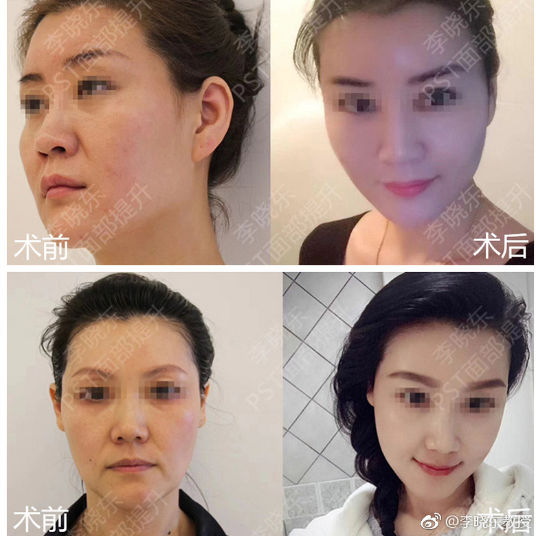 �沿���ữר��������������֢��PST�沿�������־�