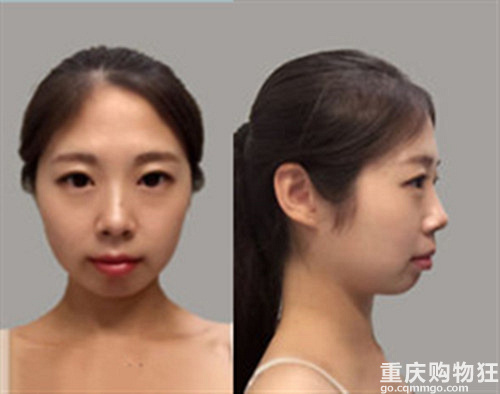 牙齿矫正后，侧面看起来不再是扁平的一条线