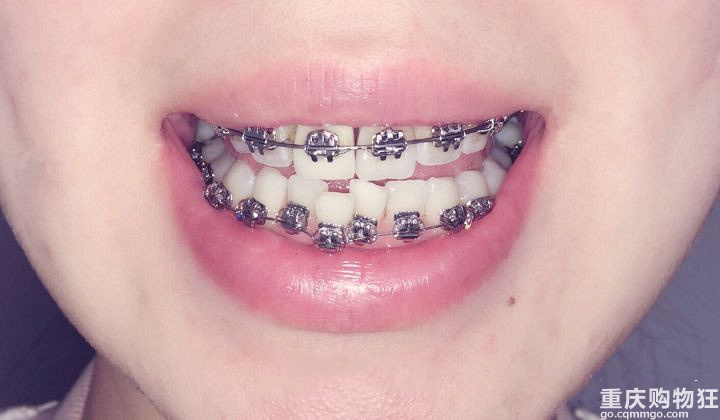 牙齿矫正后，侧面看起来不再是扁平的一条线