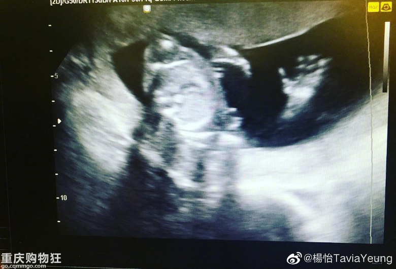 40岁杨怡怀孕晒b超公布喜讯，曝预产期在5月！杨怡怀孕上热搜