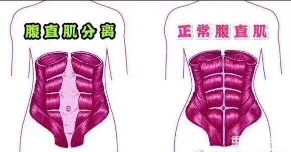 关于腹直肌，生过宝宝的姐妹看过来