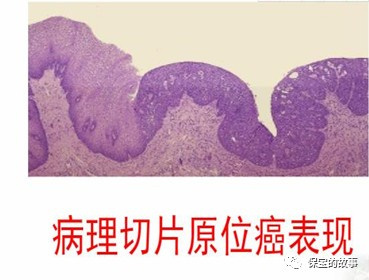重大疾病之最低敌人-恶性肿瘤
